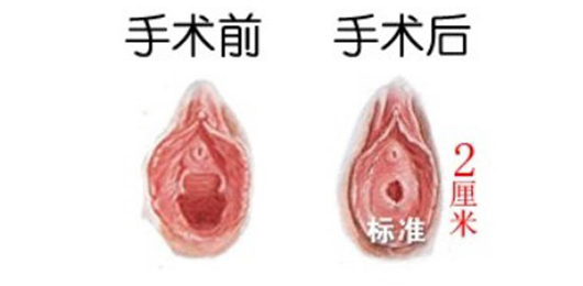 处女膜